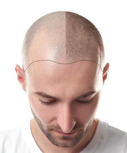 Hair Transplant